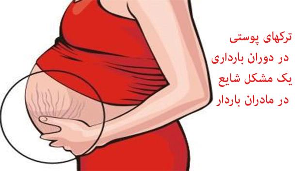 چرا تركهاي شكمي در بعضي مادران باردار بيشتر از بقيه است؟ چرا تركهاي شكمي در بعضي مادران باردار بيشتر از بقيه است؟